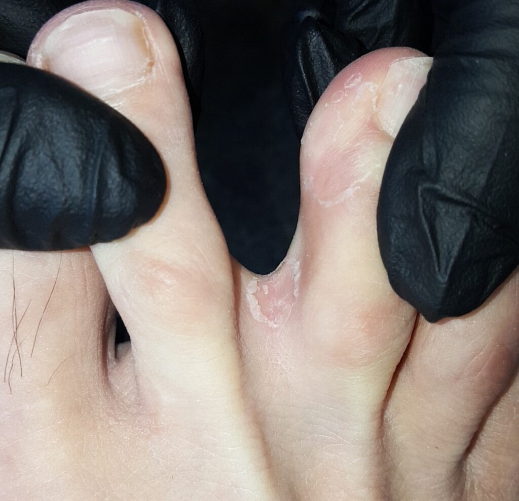 水虫 治し方 おすすめの市販水虫薬