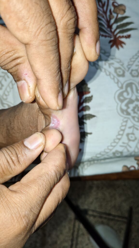 水虫 治し方 まとめ