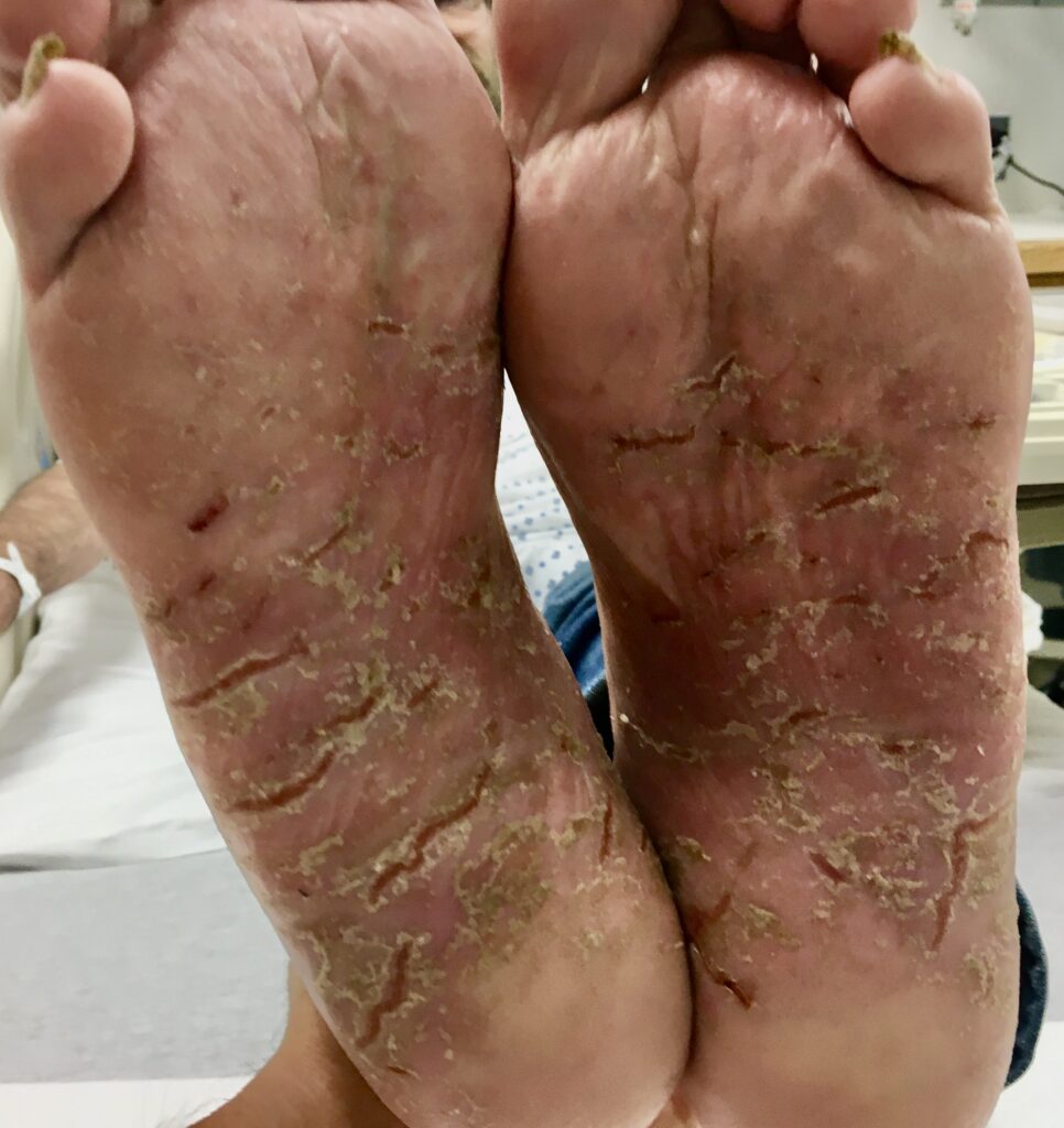 水虫 治し方 皮膚科での治療とそのメリット