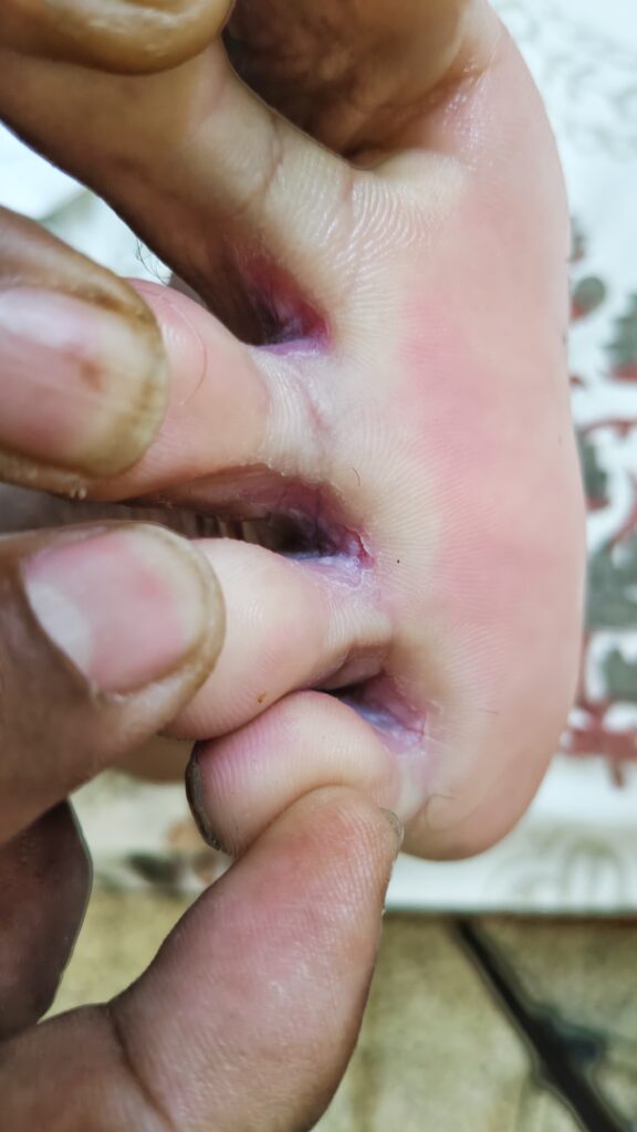 水虫 治し方 水虫の予防方法