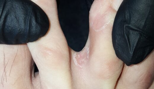 水虫の効果的な治し方とおすすめ市販薬